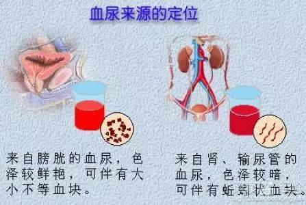 血尿病因探究 憋尿与膀胱癌的关系以及其他潜在疾病 (血尿病因学分类诊断学)