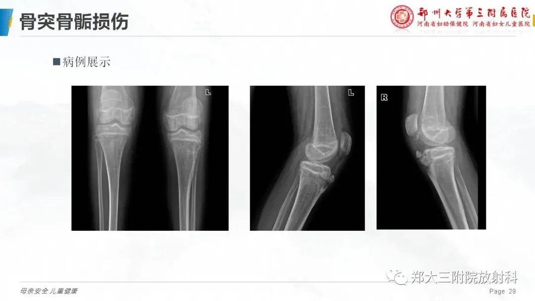 伤害宝宝骨骼的五件事 避免不当忽视 家长自检 (伤害宝宝骨骼的药)