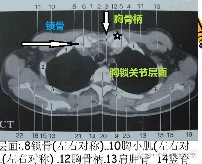 肺肿瘤患者肩膀疼痛的病因及是否会自行缓解 (肺肿瘤患者肩膀疼痛)