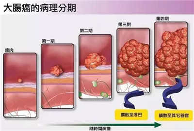 揭秘肠癌的凶险 肠癌的可怕 29岁网红确诊8月去世 (揭秘肠癌的凶手)