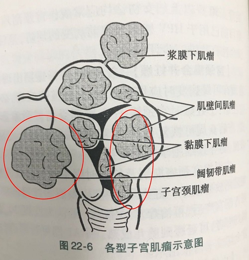 敲响子宫肌瘤这恶魔之钟 女星切除子宫肌瘤3个月后复发 (敲响子宫肌瘤会怎么样)