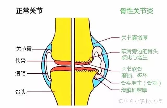 恐增加关节炎风险 常吃这类食物 70万人研究揭露 (增加骨关节炎风险的因素有)