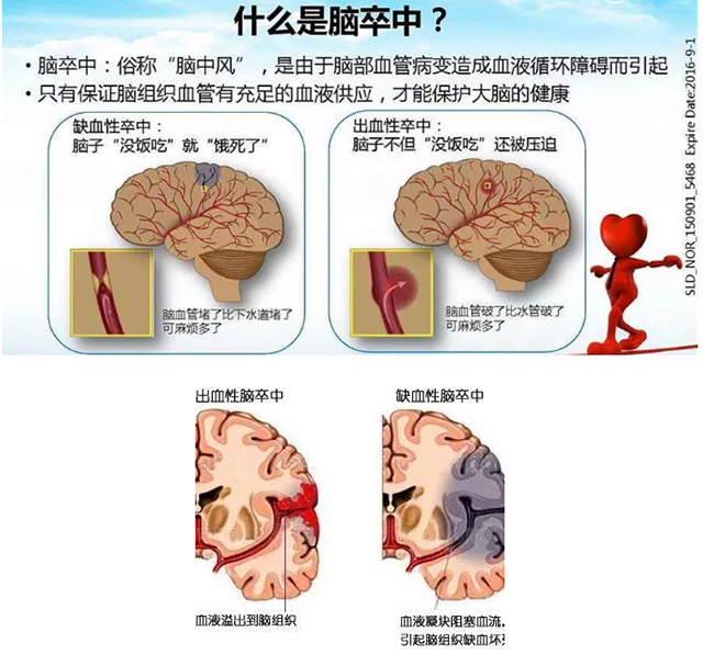 减轻脑卒中后残疾 脑卒中前降脂 美国研究揭秘 (减轻脑卒中后挛缩的方法不包括( ))